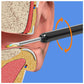 Earwax Removal Kit